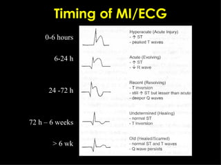 Timing of MI/ECG 0-6 hours 6-24 h 24 -72 h 72 h – 6 weeks > 6 wk 