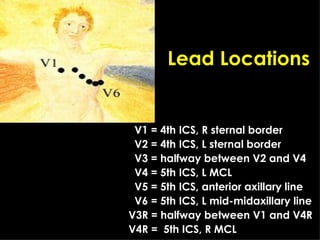 <ul><li>V1 = 4th ICS, R sternal border </li></ul><ul><li>V2 = 4th ICS, L sternal border </li></ul><ul><li>V3 = halfway bet...
