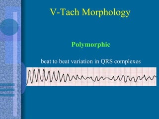 <ul><li>Polymorphic </li></ul><ul><li>beat to beat variation in QRS complexes </li></ul>V-Tach Morphology 