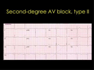Second-degree AV block, type II 