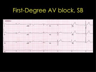 First-Degree AV block, SB 