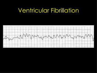 Ventricular Fibrillation 