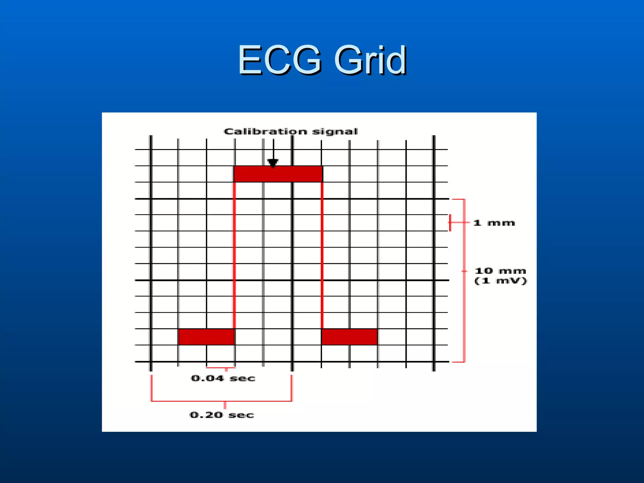 Ecg interpretation | PPT