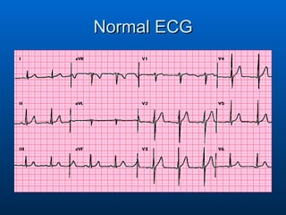 Normal ECG 