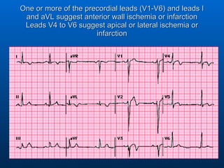 One or more of the precordial leads (V1-V6) and leads I and aVL suggest anterior wall ischemia or infarction Leads V4 to V6 suggest apical or lateral ischemia or infarction 