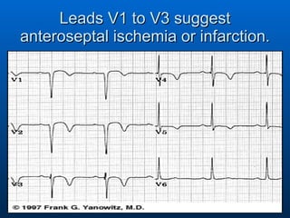 Leads V1 to V3 suggest anteroseptal ischemia or infarction. 