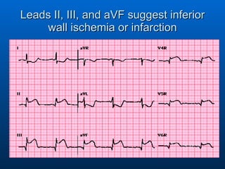 Leads II, III, and aVF suggest inferior wall ischemia or infarction 