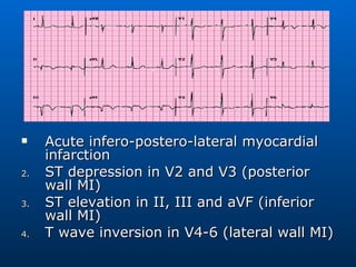 Acute infero-postero-lateral myocardial infarction ST depression in V2 and V3 (posterior wall MI) ST elevation in II, III and aVF (inferior wall MI) T wave inversion in V4-6 (lateral wall MI)  