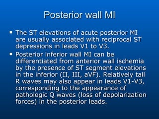 Posterior wall MI The ST elevations of acute posterior MI are usually associated with reciprocal ST depressions in leads V1 to V3.  Posterior inferior wall MI can be differentiated from anterior wall ischemia by the presence of ST segment elevations in the inferior (II, III, aVF). Relatively tall R waves may also appear in leads V1-V3, corresponding to the appearance of pathologic Q waves (loss of depolarization forces) in the posterior leads.  