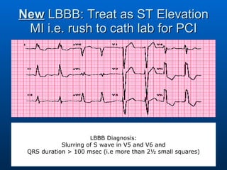 New  LBBB: Treat as ST Elevation MI i.e. rush to cath lab for PCI LBBB Diagnosis: Slurring of S wave in V5 and V6 and QRS duration > 100 msec (i.e more than 2½ small squares) 