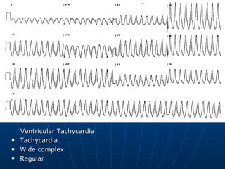Ventricular Tachycardia Tachycardia Wide complex Regular 