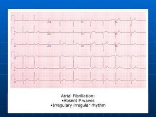 Atrial Fibrillation: Absent P waves Irregulary irregular rhythm 