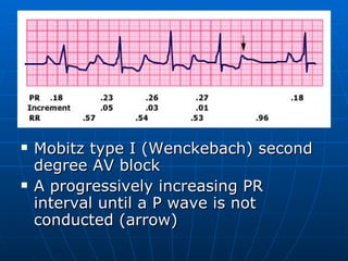 Mobitz type I (Wenckebach) second degree AV block  A progressively increasing PR interval until a P wave is not conducted (arrow)  