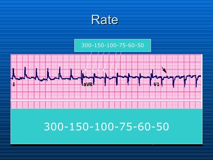 Ecg Interpretation