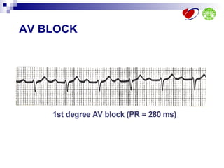 Ecg interpretation | PPT