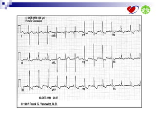 Ecg interpretation | PPT