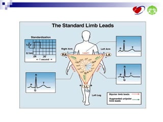 Ecg interpretation | PPT