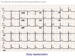 Ecg interpretation | PPT