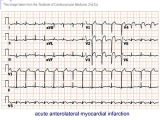 Ecg interpretation | PPT