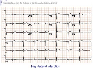 Ecg interpretation | PPT