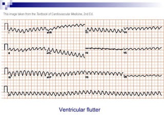 Ecg interpretation | PPT