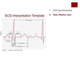 ECG Interpretation Template
1. ECG type &recording
2. Rate, Rhythm, Axis
 