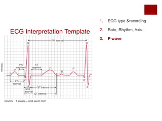 ECG Interpretation Template
1. ECG type &recording
2. Rate, Rhythm, Axis
3. P wave
 