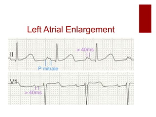 Left Atrial Enlargement
 