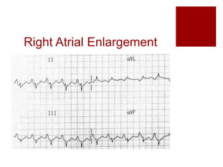 Right Atrial Enlargement
 