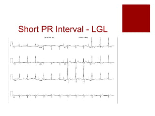 Short PR Interval - LGL
 