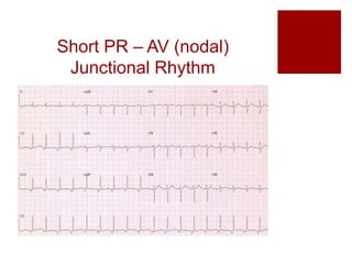 Short PR – AV (nodal)
Junctional Rhythm
 