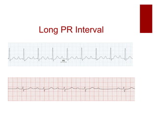 Long PR Interval
 