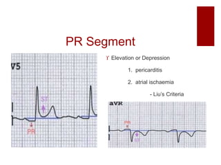 PR Segment
 Elevation or Depression
1. pericarditis
2. atrial ischaemia
- Liu’s Criteria
 