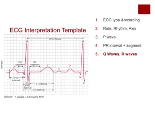 ECG Interpretation Template
1. ECG type &recording
2. Rate, Rhythm, Axis
3. P wave
4. PR interval + segment
5. Q Waves, R waves
 