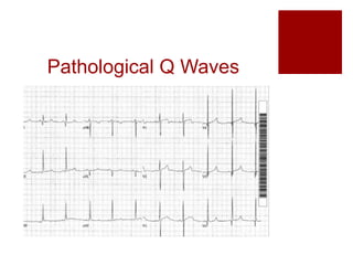 Pathological Q Waves
 