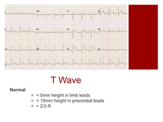 T Wave
Normal
= < 5mm height in limb leads
= < 15mm height in precordial leads
= < 2/3 R
 