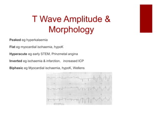 T Wave Amplitude &
Morphology
Peaked eg hyperkalaemia
Flat eg myocardial ischaemia, hypoK
Hyperacute eg early STEM, Prinzmetal angina
Inverted eg ischaemia & infarction, increased ICP
Biphasic eg Myocardial ischaemia, hypoK, Wellens
 