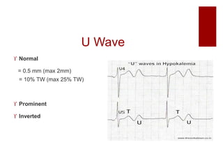 U Wave
 Normal
= 0.5 mm (max 2mm)
= 10% TW (max 25% TW)
 Prominent
 Inverted
 
