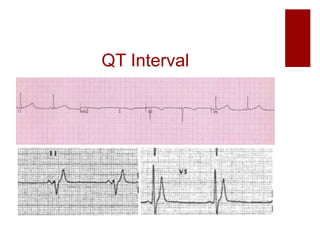QT Interval
 