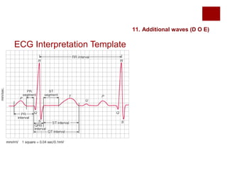 ECG Interpretation Template
11. Additional waves (D O E)
 