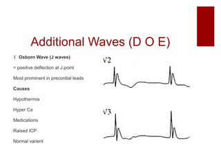 Additional Waves (D O E)
 Osborn Wave (J waves)
= positive deflection at J point
Most prominent in precordial leads
Causes
Hypothermia
Hyper Ca
Medications
Raised ICP
Normal varient
 