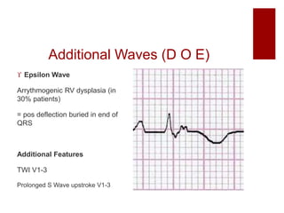 Additional Waves (D O E)
 Epsilon Wave
Arrythmogenic RV dysplasia (in
30% patients)
= pos deflection buried in end of
QRS
Additional Features
TWI V1-3
Prolonged S Wave upstroke V1-3
 