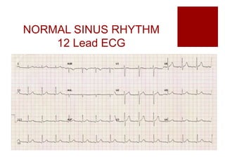 Normal Eg ECG interpretation | PPTX