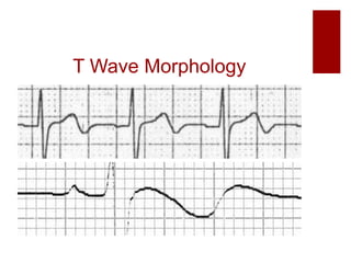 ECG interpretation | PPTX