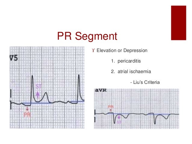 ecg interpretation