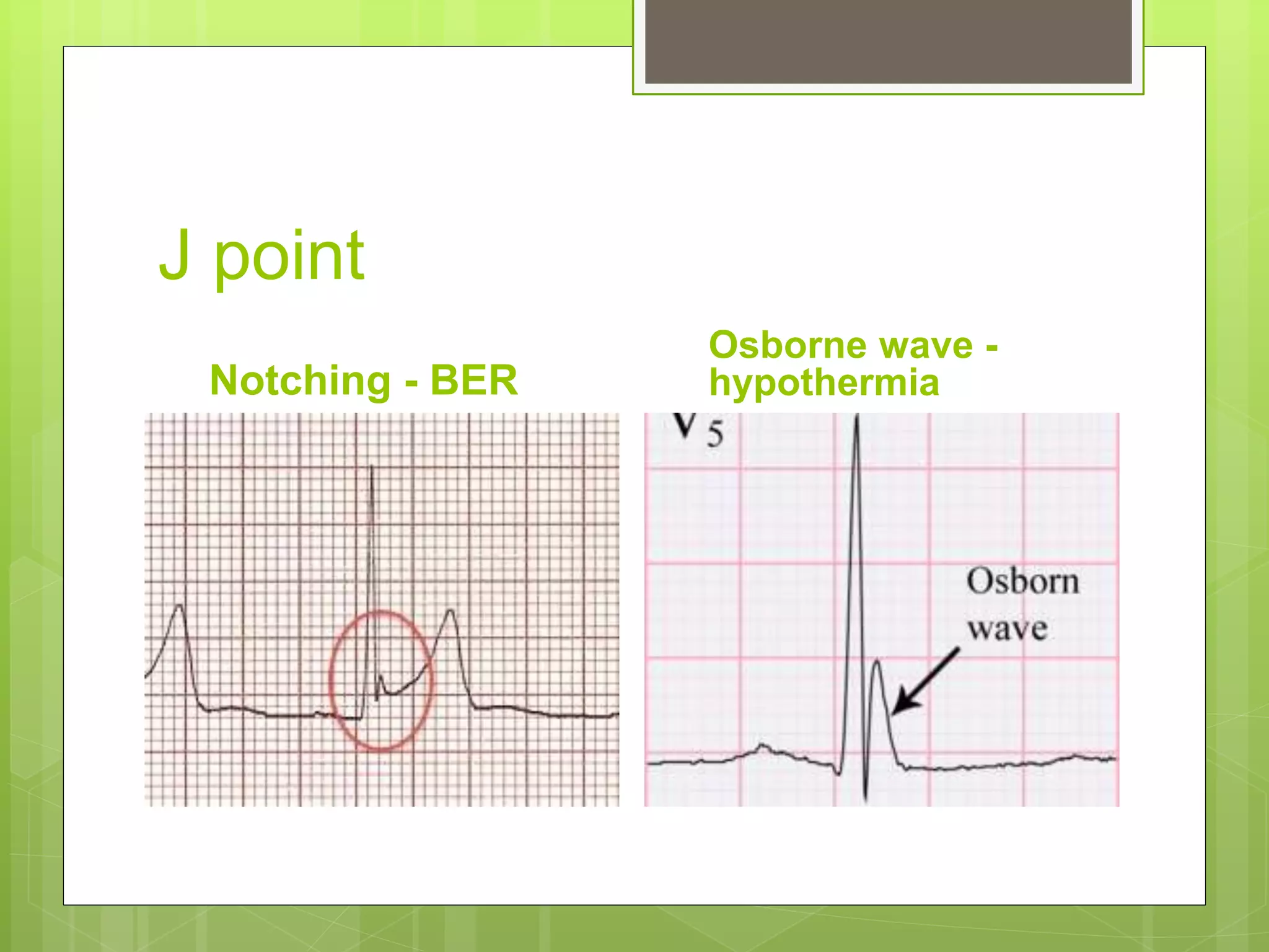 J point
Notching - BER
Osborne wave -
hypothermia
 