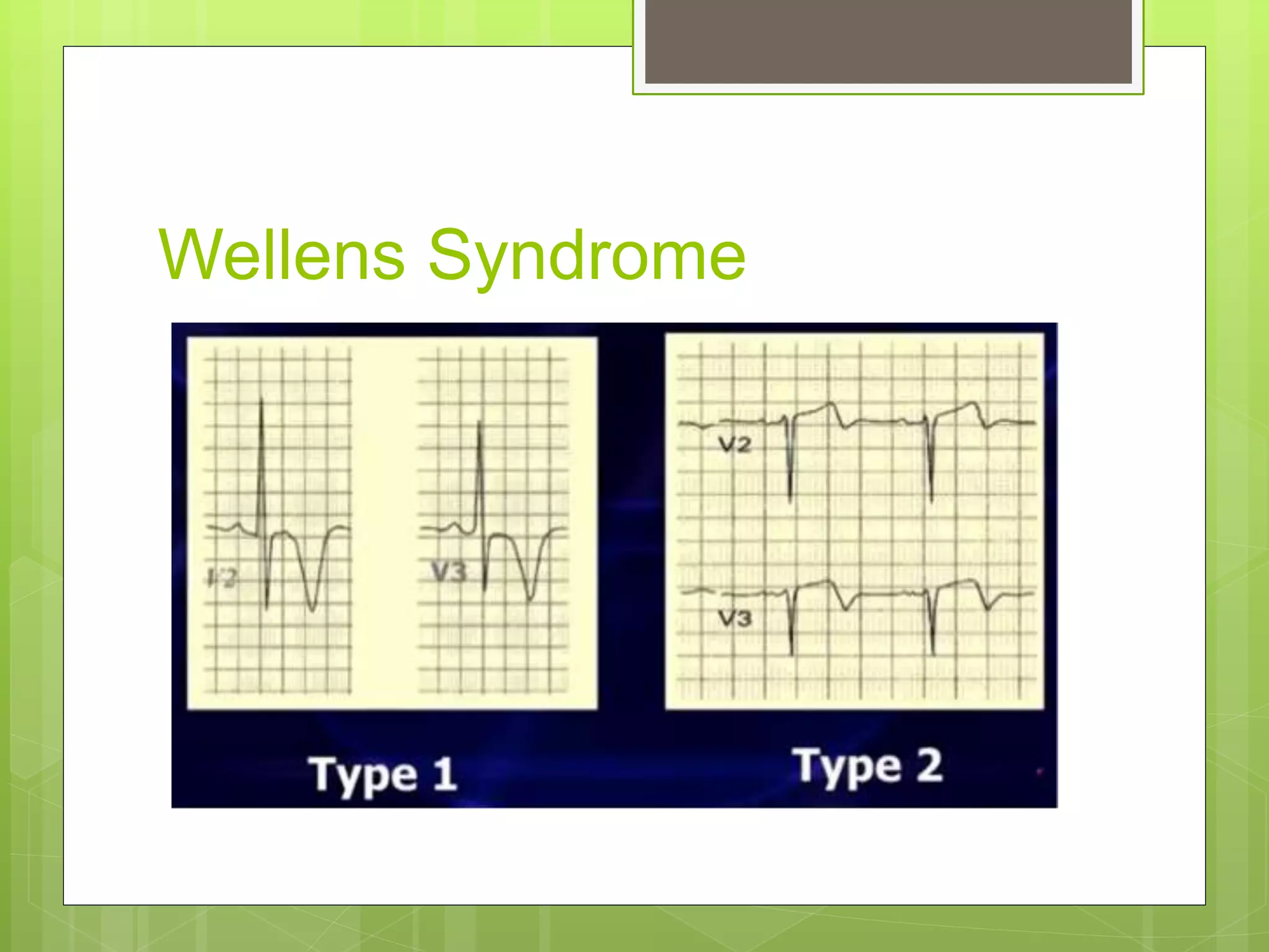 Wellens Syndrome
 