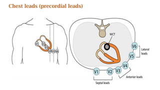 Chest leads (precordial leads)
 