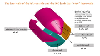 The four walls of the left ventricle and the ECG leads that “view” these walls
 