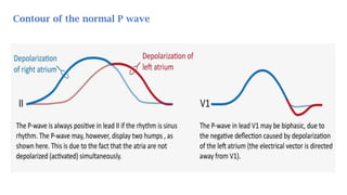 Contour of the normal P wave
 